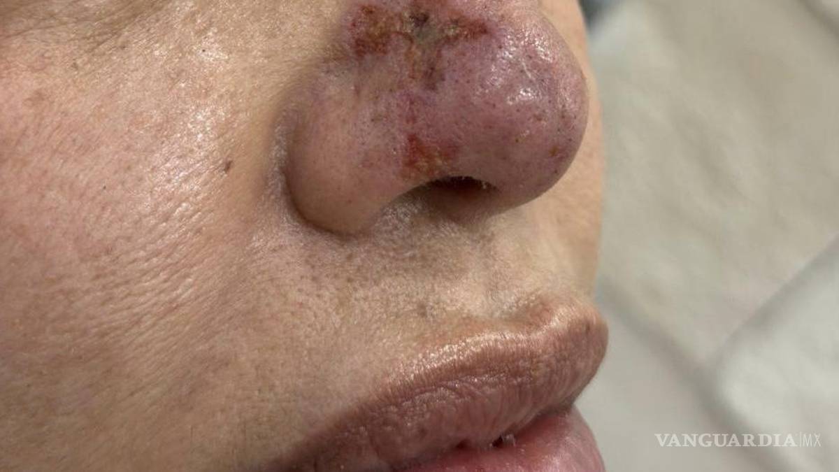 Le provocan lesiones graves en la nariz tras intervención estética, en Saltillo