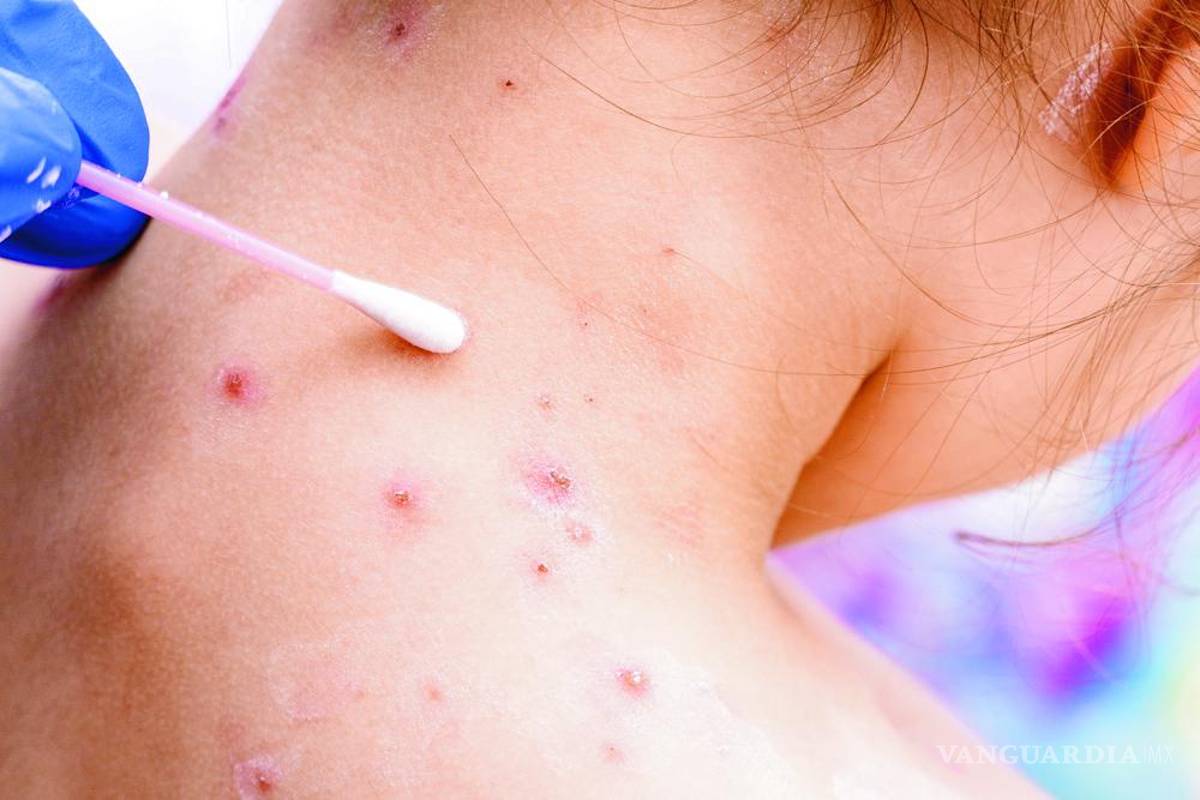 Estudian 11 casos sospechosos de viruela del mono en Coahuila; montan cerco epidemiológico en entorno familiar