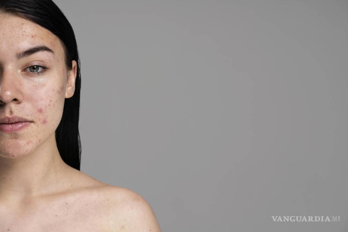 $!Ya soy adulto, ¿por qué me sale acné?