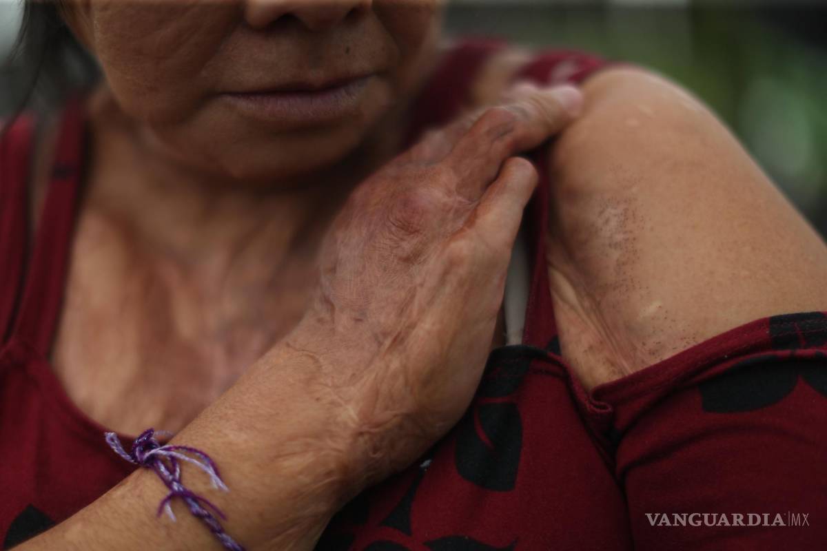 $!Elisa Xolalpa, mujer sobreviviente de ataque con ácido por su entonces pareja Ciudad de México (México).