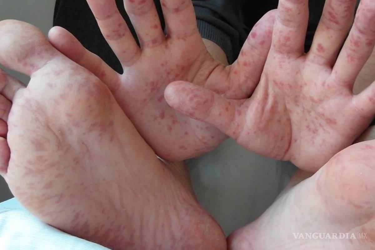 ¿Qué es el virus coxsackie?... pone en jaque a escuelas de varios estados de México