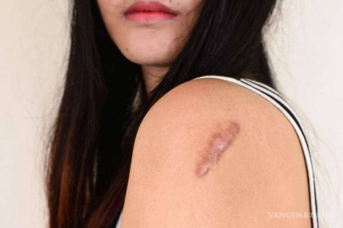 ¿Qué son las Cicatrices Queloides y Cómo Tratarlas?