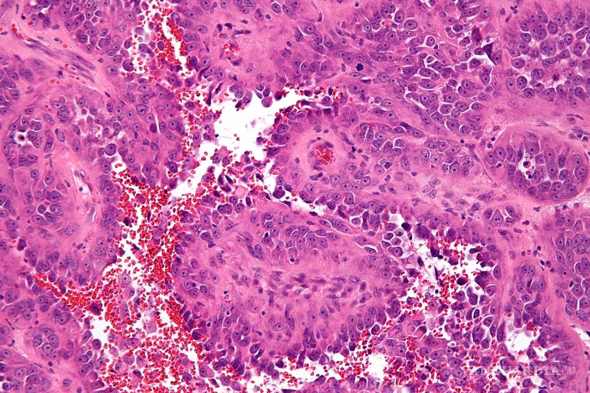 Estudio con pacientes de angiosarcoma revela posibles nuevas terapias