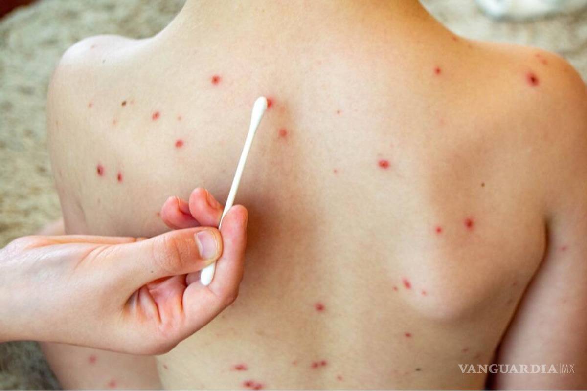 Reportan primer caso confirmado de sarampión en Saltillo; Coahuila suma 10 contagios