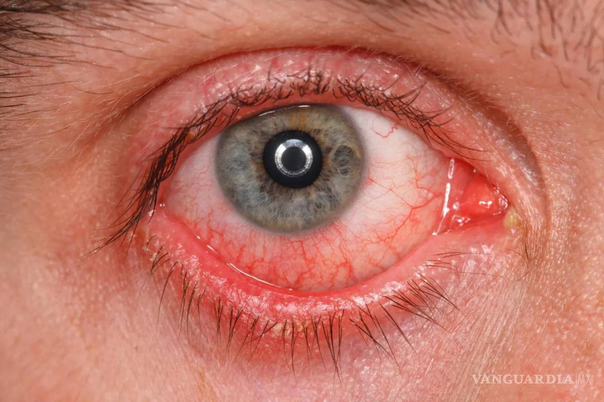 $!Ojo rojo, picor y lagrimeo... ¡Ojo!, una conjuntivitis puede ir más allá de una simple molestia. Con la llegada de la primavera y el aumento de alérgenos como el polen, los casos de picor ocular, lagrimeo y enrojecimiento se vuelven más frecuentes incluso en las personas que no suelen padecer de alérgicas.