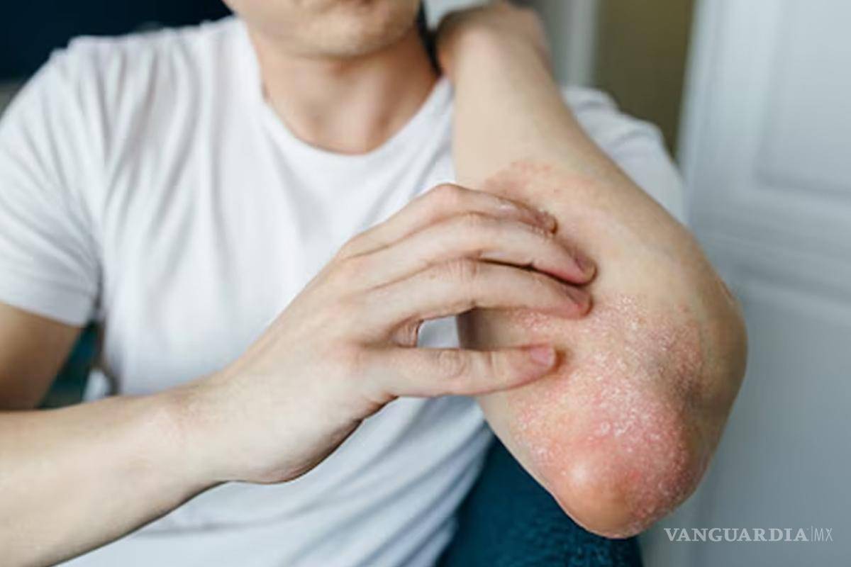 Alerta por aumento de contagios por superhongo resistente a medicinas