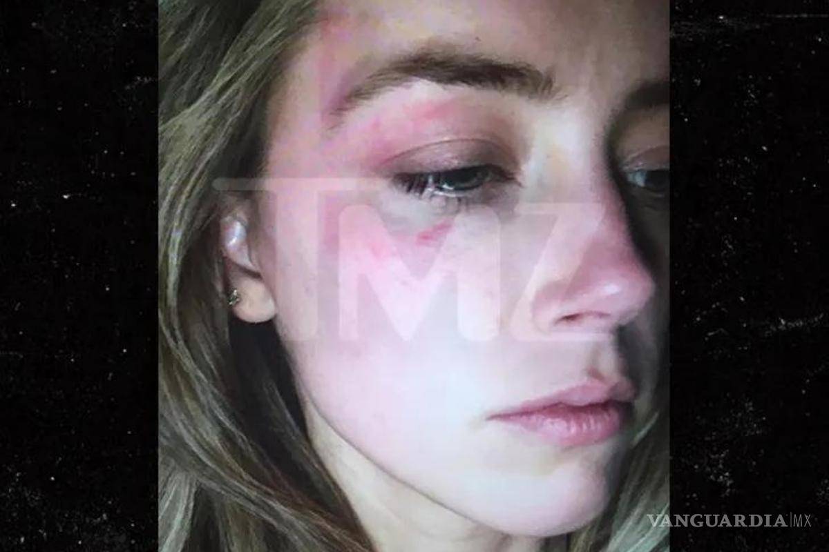 $!Fotografía que divulgó en 2016 el sitio TMZ que muestra a Amber Heard con “supuestos moretones”.