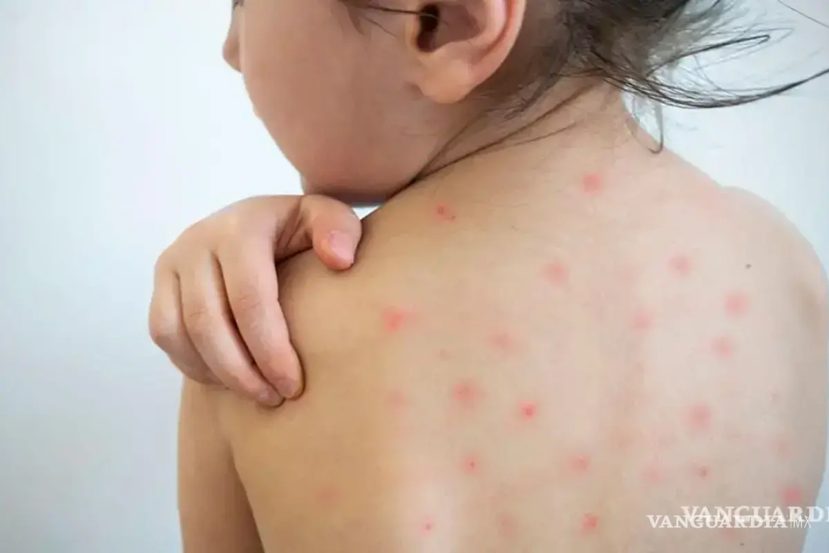 Coahuila reporta 51 casos de sarampión; continúa vigilancia epidemiológica