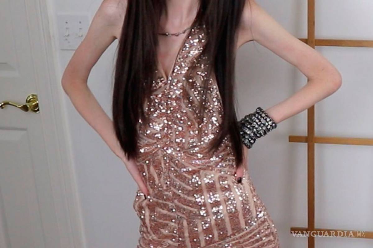 Autorizan a padres alimentar por la fuerza a hija que padece anorexia