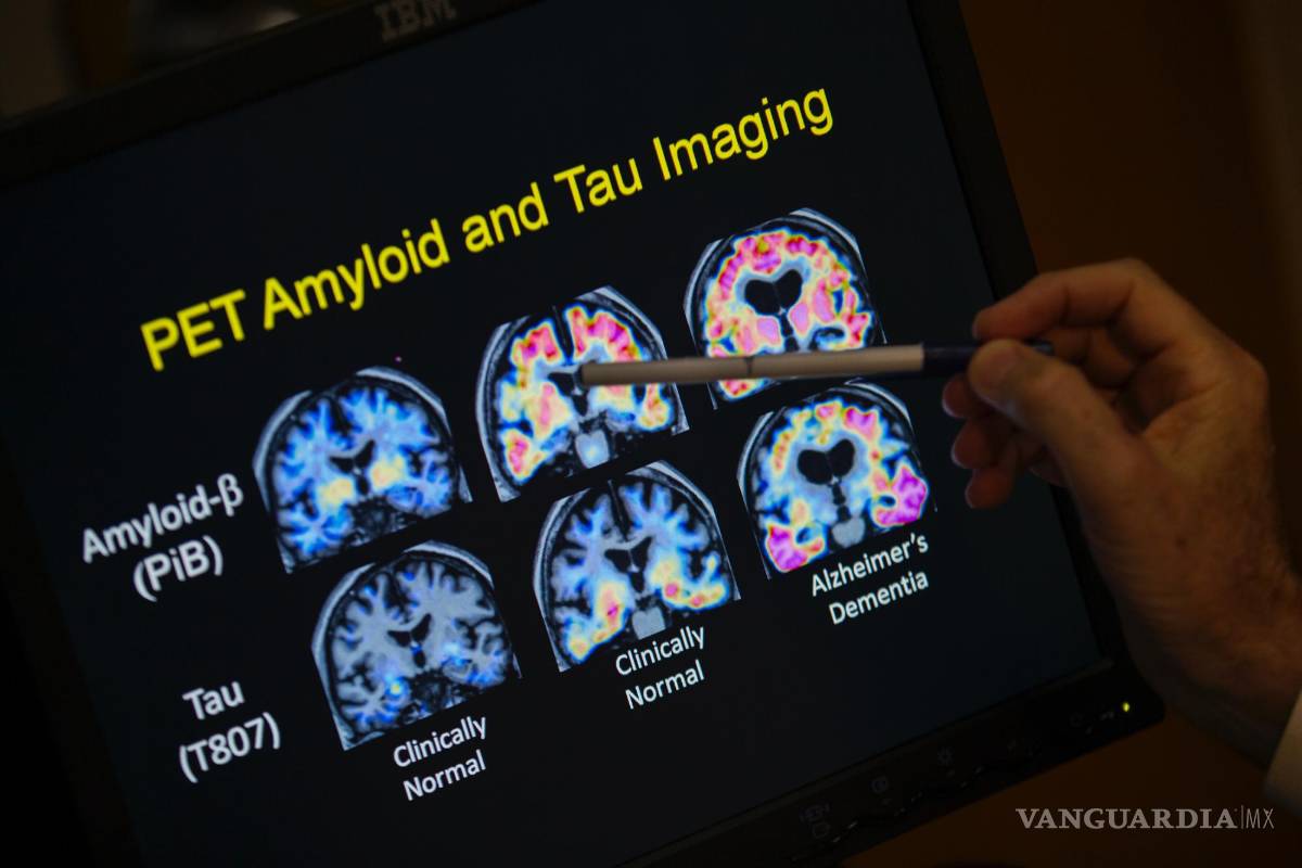 $!Un médico señala imágenes de un escáner cerebral dentro de un estudio sobre el Alzheimer en el hospital de la Universidad de Georgetown, el 19 de mayo de 2015.