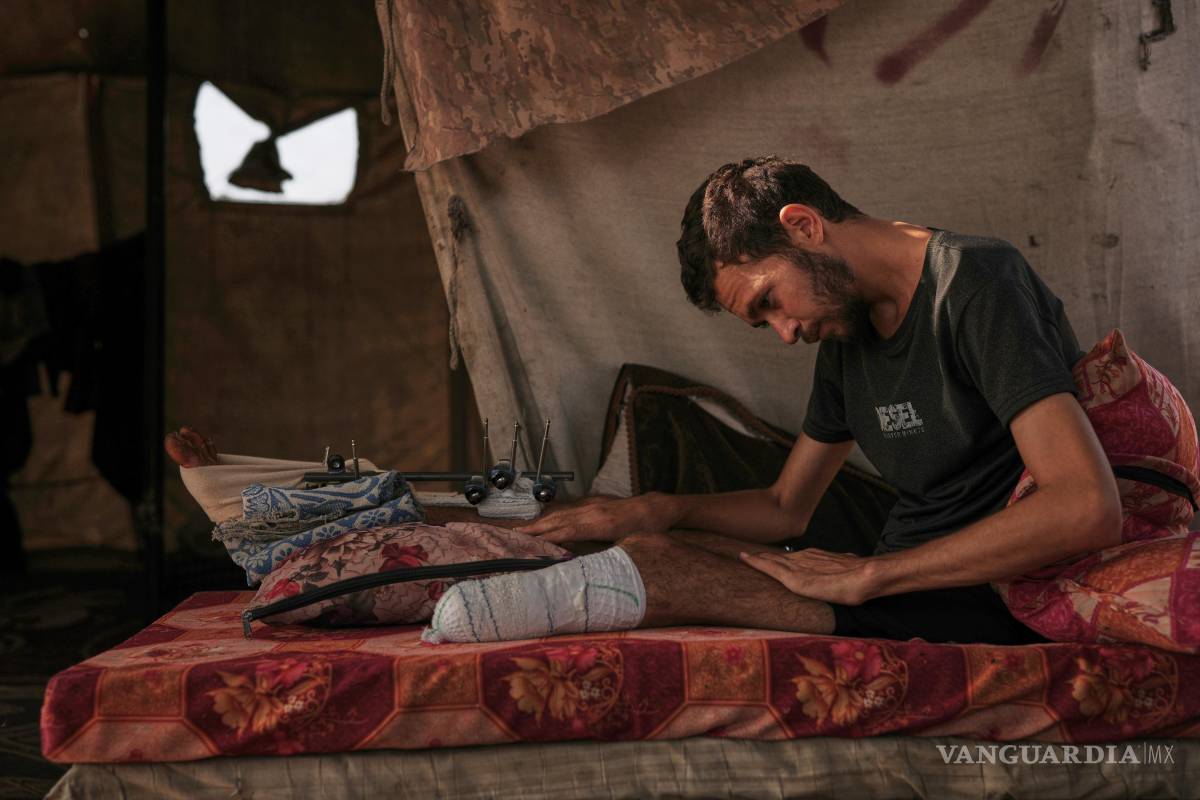 Amputados en Gaza luchan por reconstruir sus vidas ante la escasez de prótesis