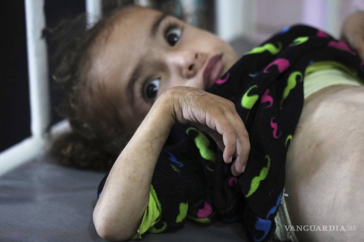 $!Mayar Al-Arja, un niño de 2 años que sufre de desnutrición, en el Hopsital Nasser de Jan Yunis en la Franja de Gaza.