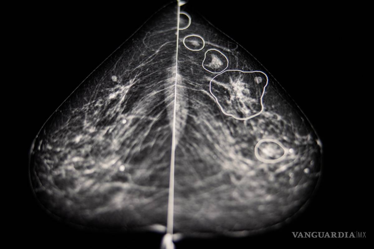 Usan inteligencia artificial para detectar el cáncer de mama que los médicos no ven
