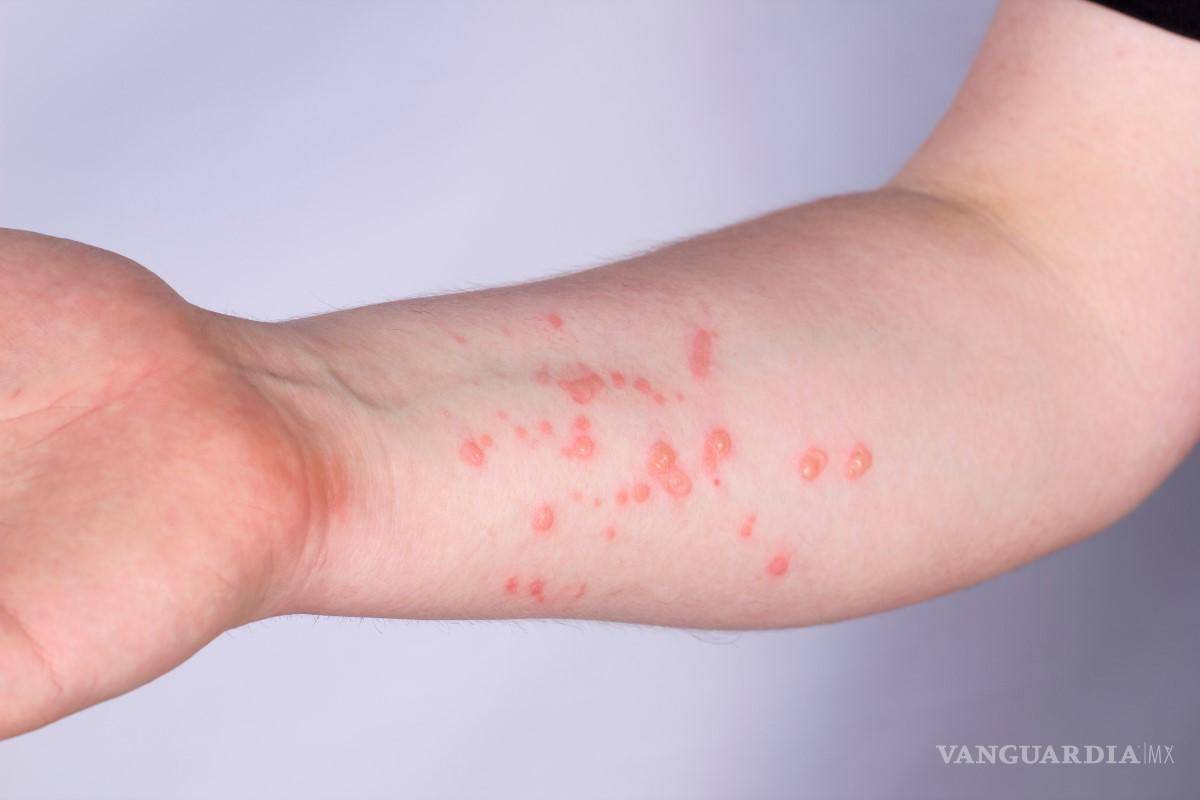 ¡Cuidado! Así puede afectar viruela del mono al corazón, según estudio