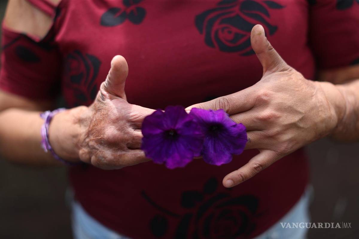 $!Elisa Xolalpa, mujer sobreviviente de ataque con ácido por su entonces pareja Ciudad de México (México).