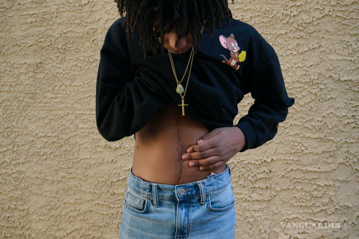 $!Caison Robinson, de 14 años, quien sufrió heridas de cinco disparos que fueron disparados en cuestión de momentos, muestra una cicatriz de su cirugía.