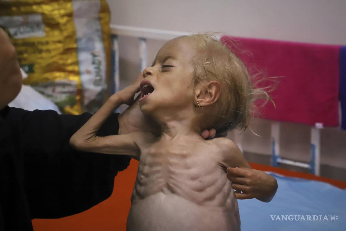 $!Islam Qudeih con su hija de 2 años, Shamm, gravemente desnutrida y sin camisa en el Hospital Nasser de Khan Younis, al sur de la Franja de Gaza.