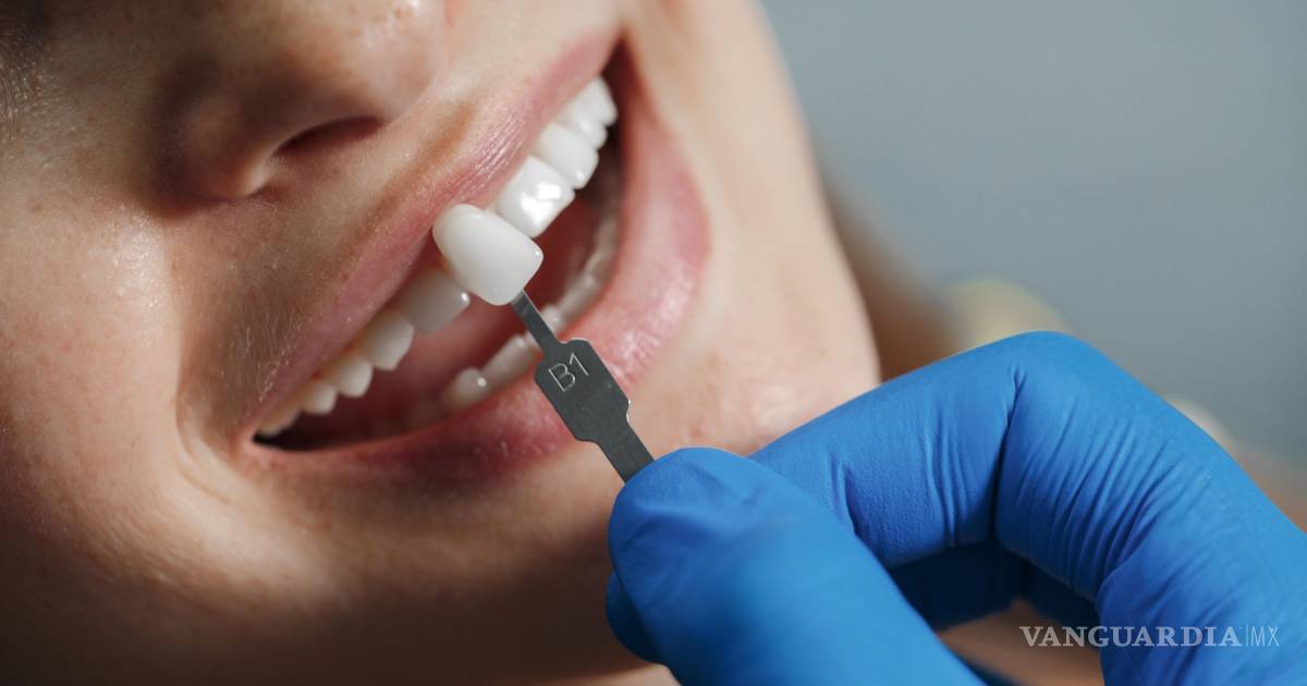 ¿Estética o salud? Lo que debes saber antes de someterte a carillas dentales