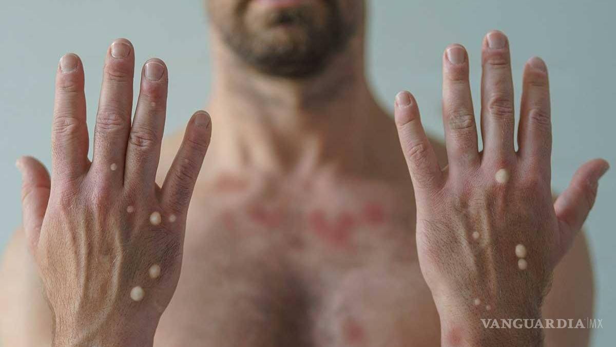 Hay riesgo de contagios por caso de viruela símica, dice Alcade de Monclova