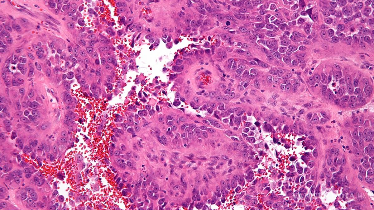 Estudio con pacientes de angiosarcoma revela posibles nuevas terapias