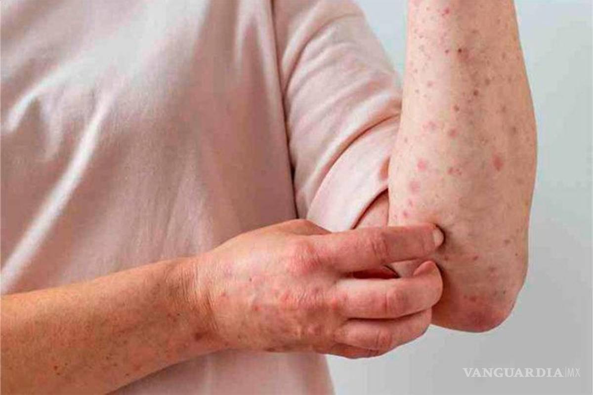 Trabajador de la Secretaría de Salud Piedras Negras es sospechoso de viruela símica