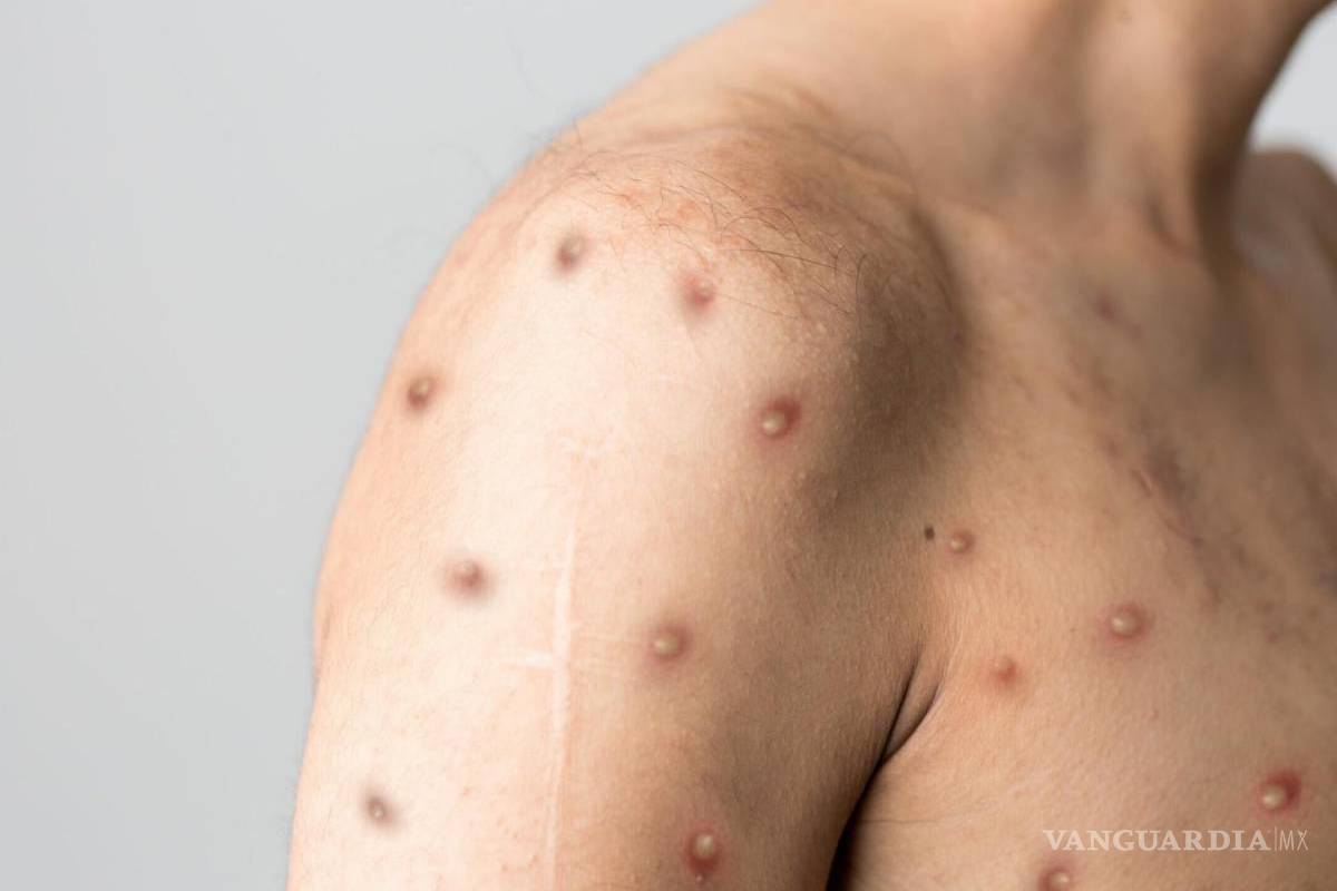 Identifican a sinaloenses que fueron a fiesta en Puerto Vallarta, tras detectar caso de viruela símica