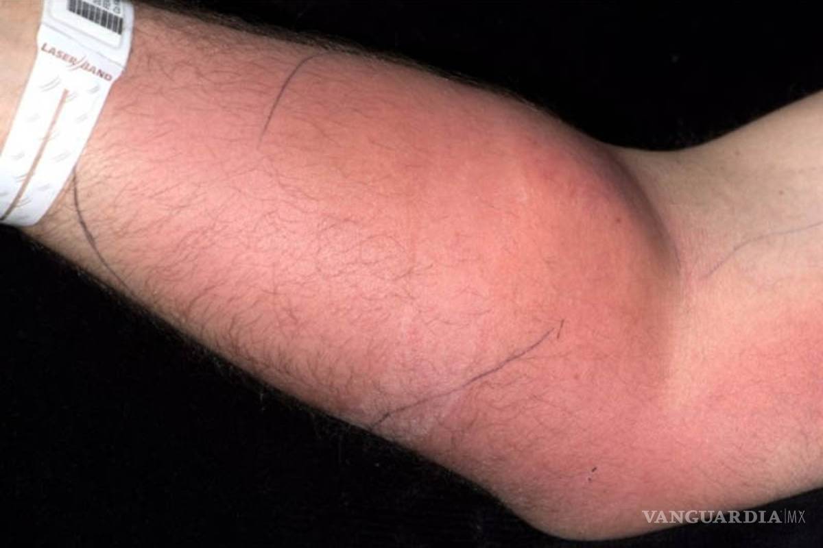 $!Se inyectó semen para curarse un dolor y esto fue lo que pasó...