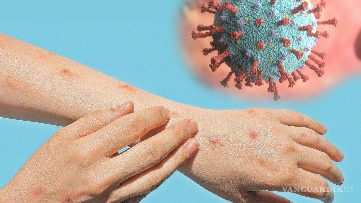 ¿Cuál es la diferencia entre mpox y la varicela? Joven mexicana las confunde y se vuelve viral