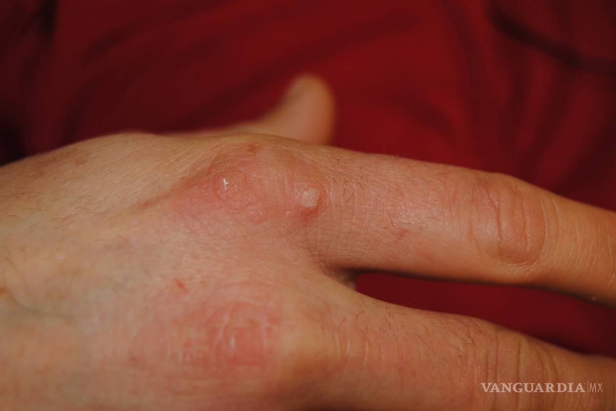 Papiloma humano en hombres desarrolla cáncer de ano y pene