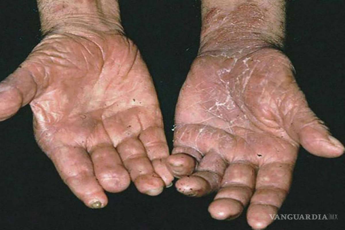 Reportan casos de lepra en Quintana Roo y Yucatán