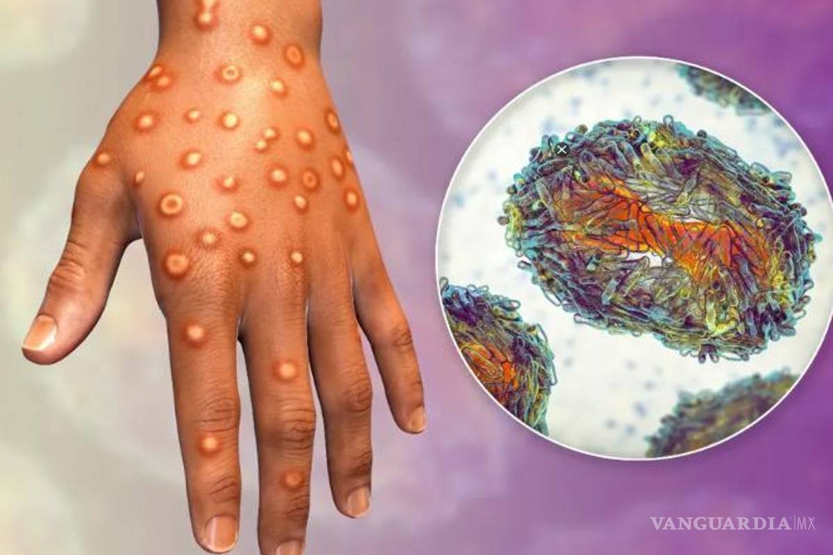 México ya supera los mil casos de viruela del mono