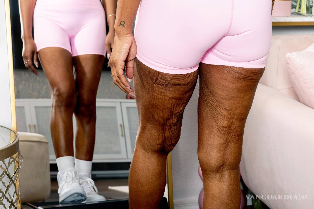 ¿Qué pasa con la piel después de perder mucho peso? Consecuencias y soluciones reales