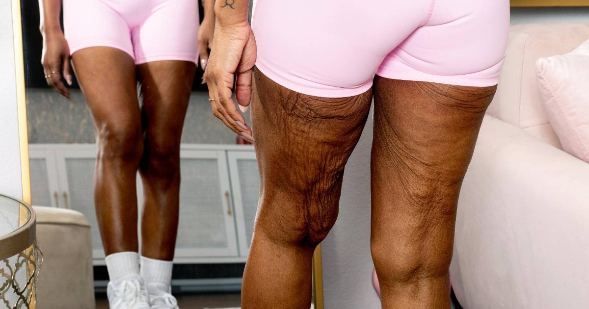 ¿Qué pasa con la piel después de perder mucho peso? Consecuencias y soluciones reales