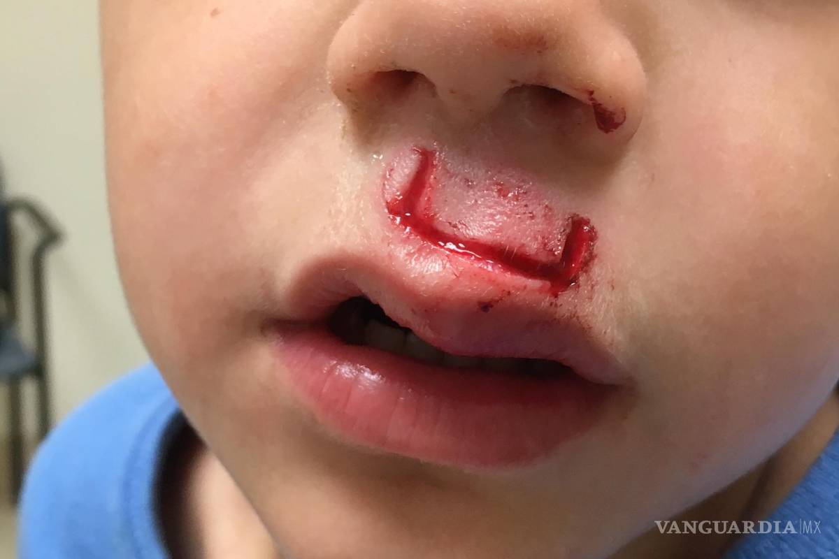 Niño sufre accidente con un spinner, termina en hospital