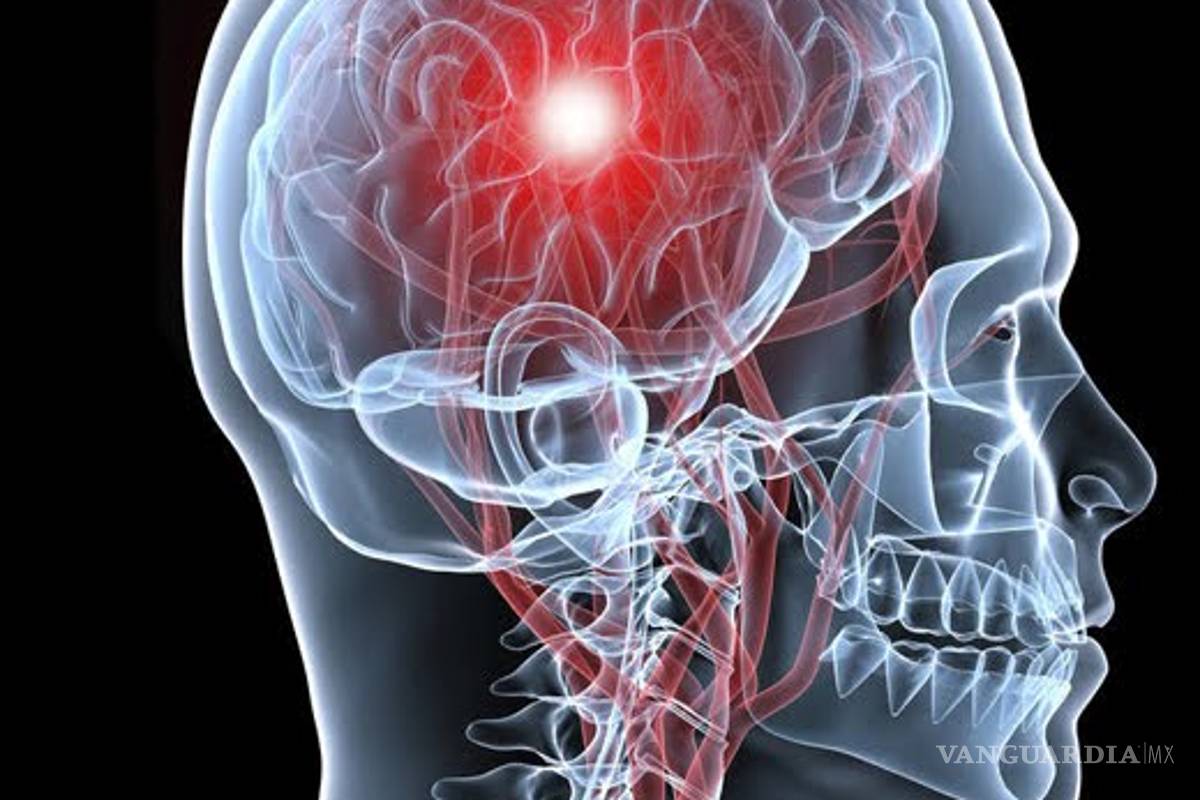 Derrame cerebral ¿Cómo prevenirlo?