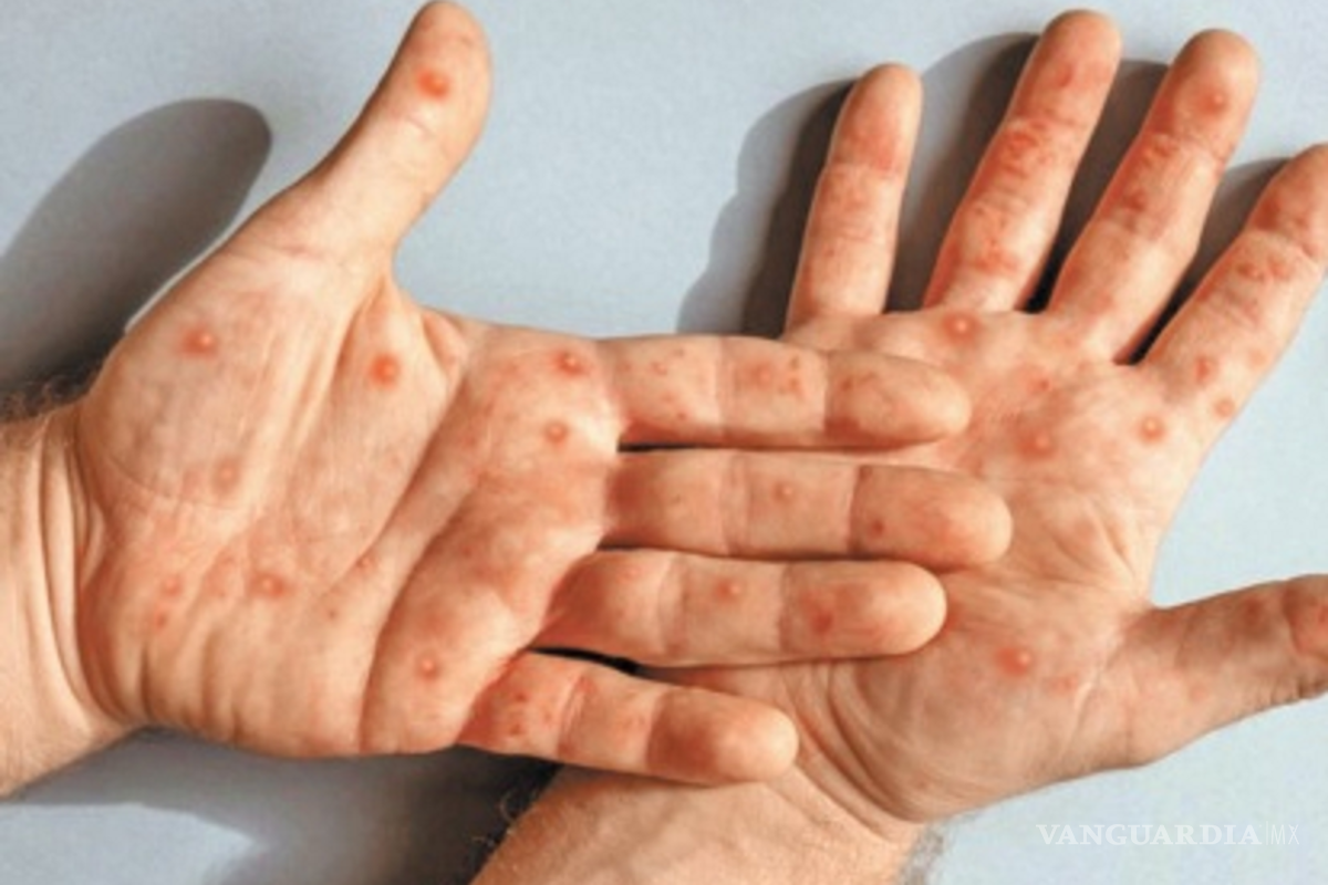 Detectan primer caso de mpox en Suecia, organismos sanitarios de Europa piden reforzar medidas