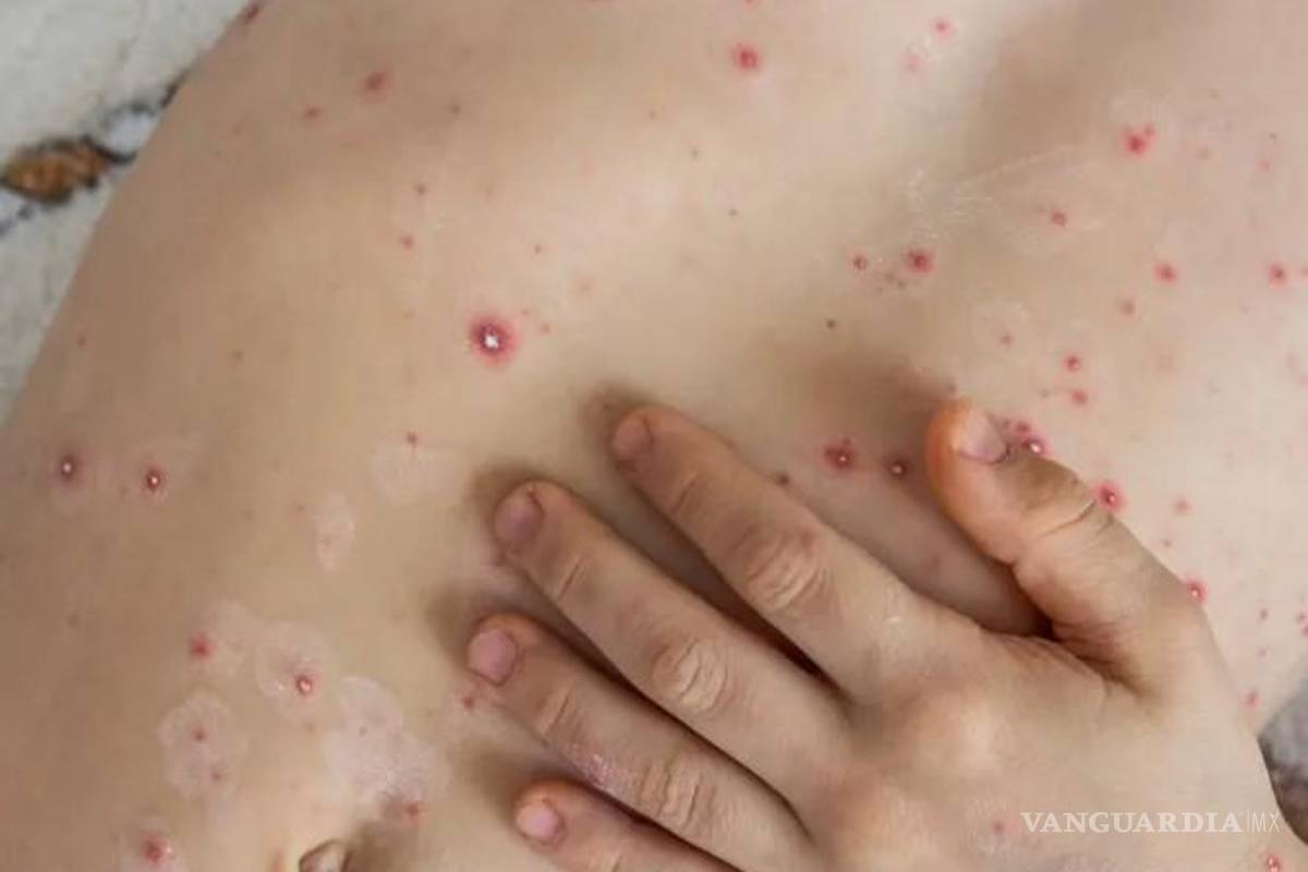 Mientras la viruela del simio se propaga, ahora llega la ‘gripe del tomate’, virus muy contagioso y detectado en niños