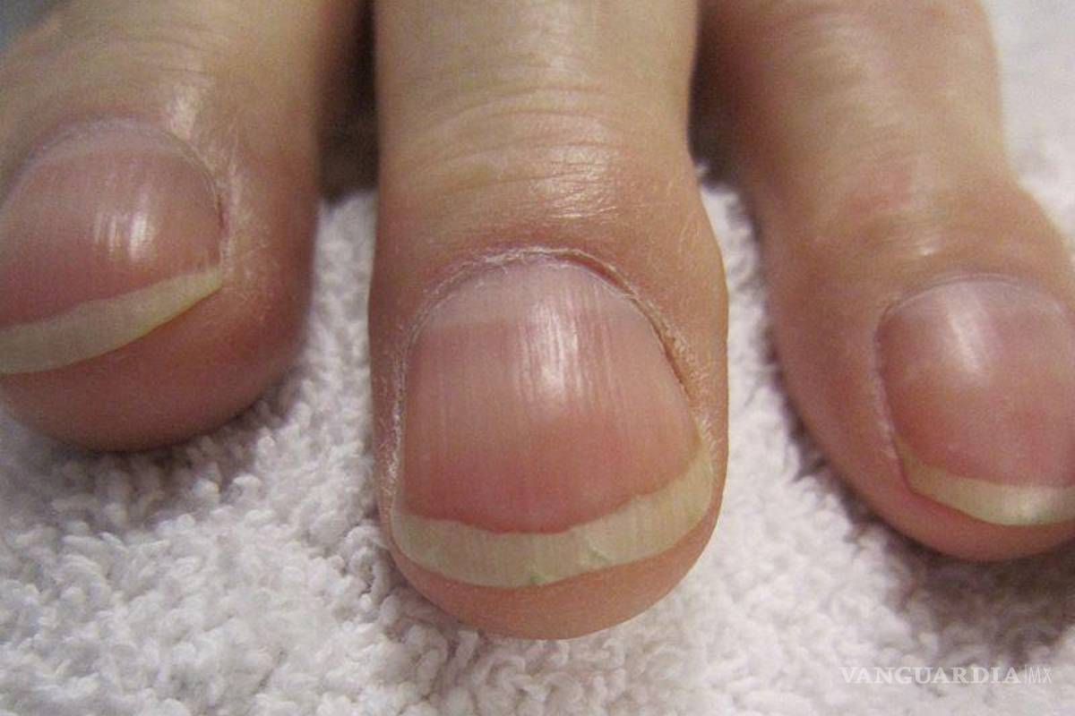 ‘Clubbing’: tus uñas dan señales de que podrías padecer cáncer. Aquí te contamos cómo identificarlas