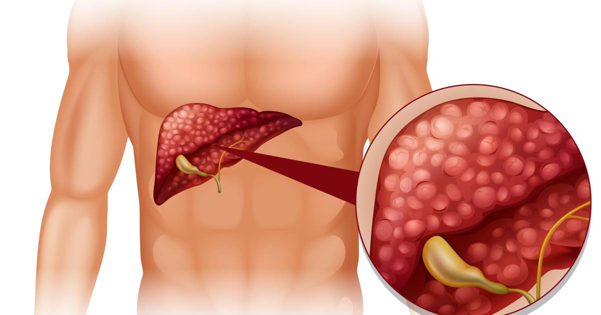 Hígado graso en aumento: la guía definitiva para reducirlo desde casa con cambios simples y efectivos