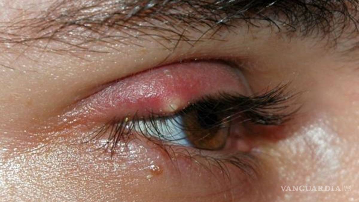 ¿Cómo curar los molestos orzuelos?