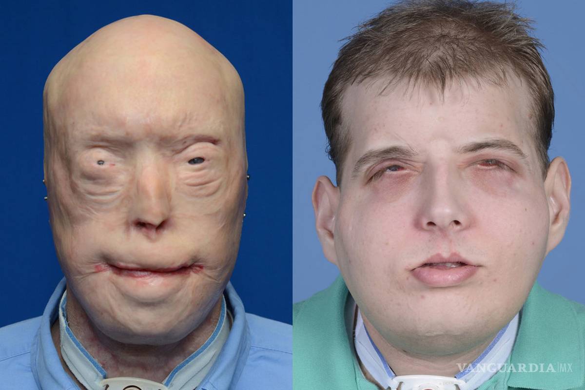 Realizan con éxito el trasplante de cara más completo del mundo