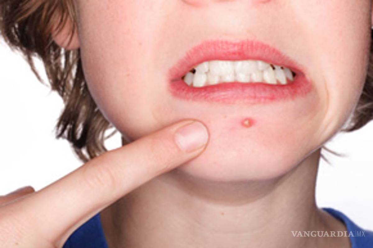 Acné: Definición y tratamiento