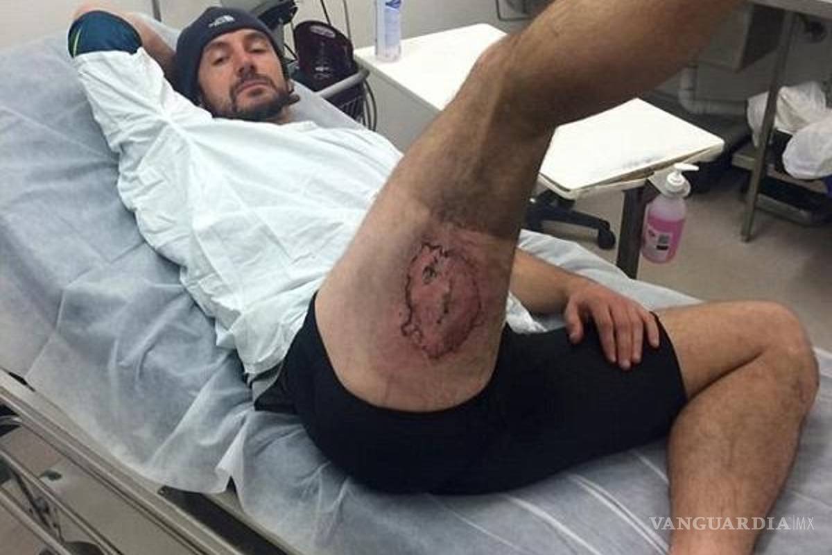 Hombre sufre graves quemaduras en la pierna tras falla de su iPhone