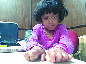 Exitosa, cirugía a niña con ‘piel de mariposa’