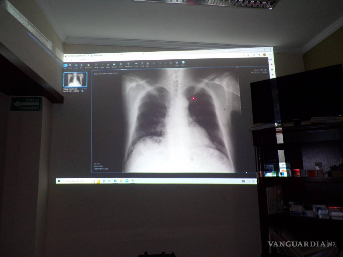 $!El pulmón negro es una de las enfermedades comunes entre los mineros, y por eso Coahuila ocupa el primer lugar nacional.