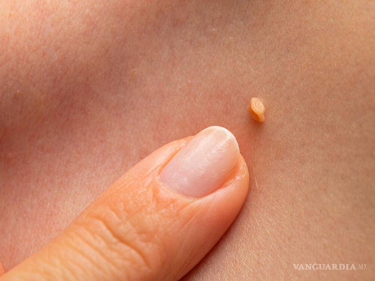 $!Los acrocordones son crecimientos blandos que sobresalen de la superficie de la piel.