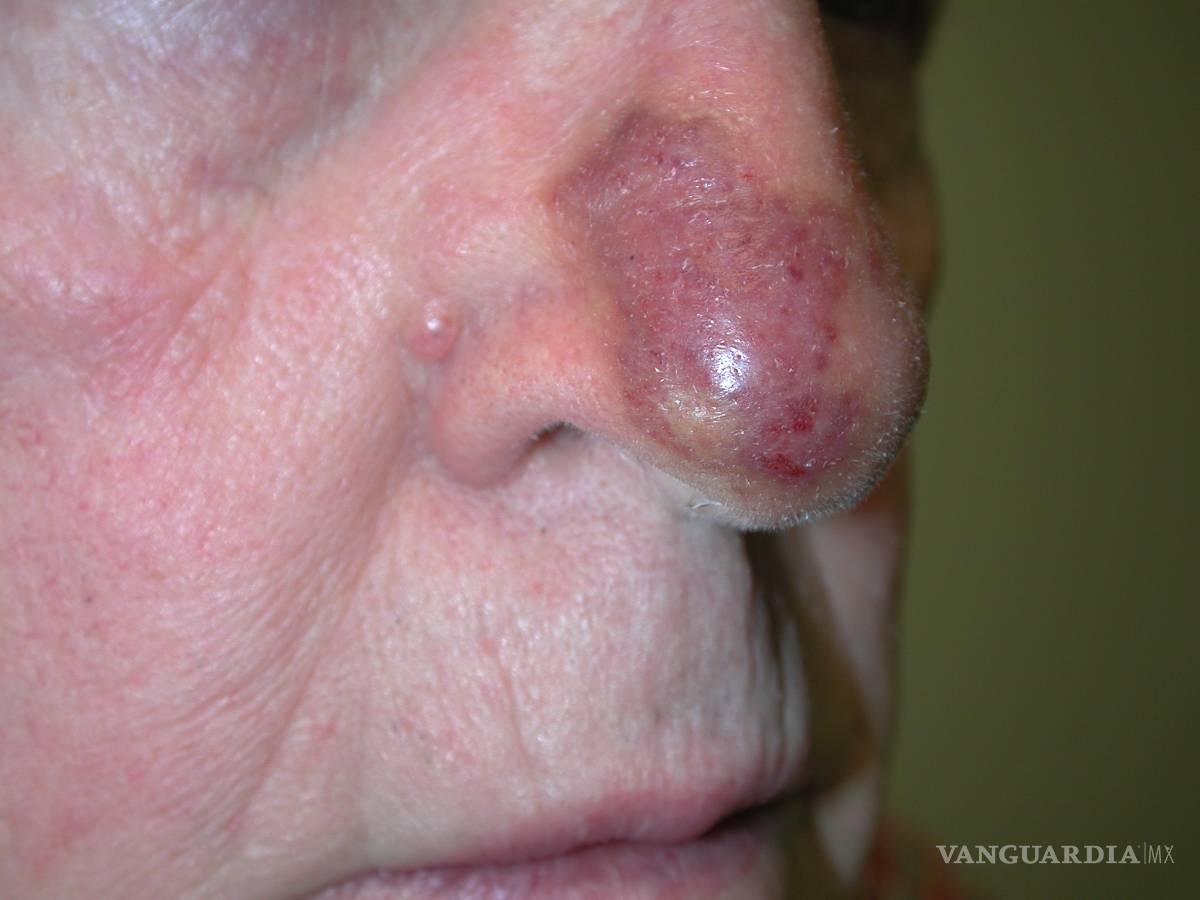 $!Estudio con pacientes de angiosarcoma revela posibles nuevas terapias