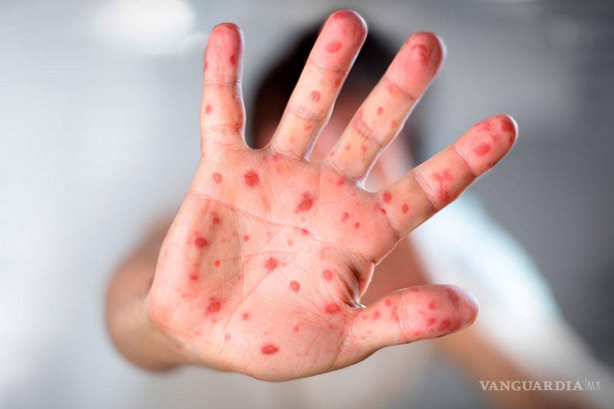 Aún no es necesaria una vacunación masiva contra la viruela del mono: OMS