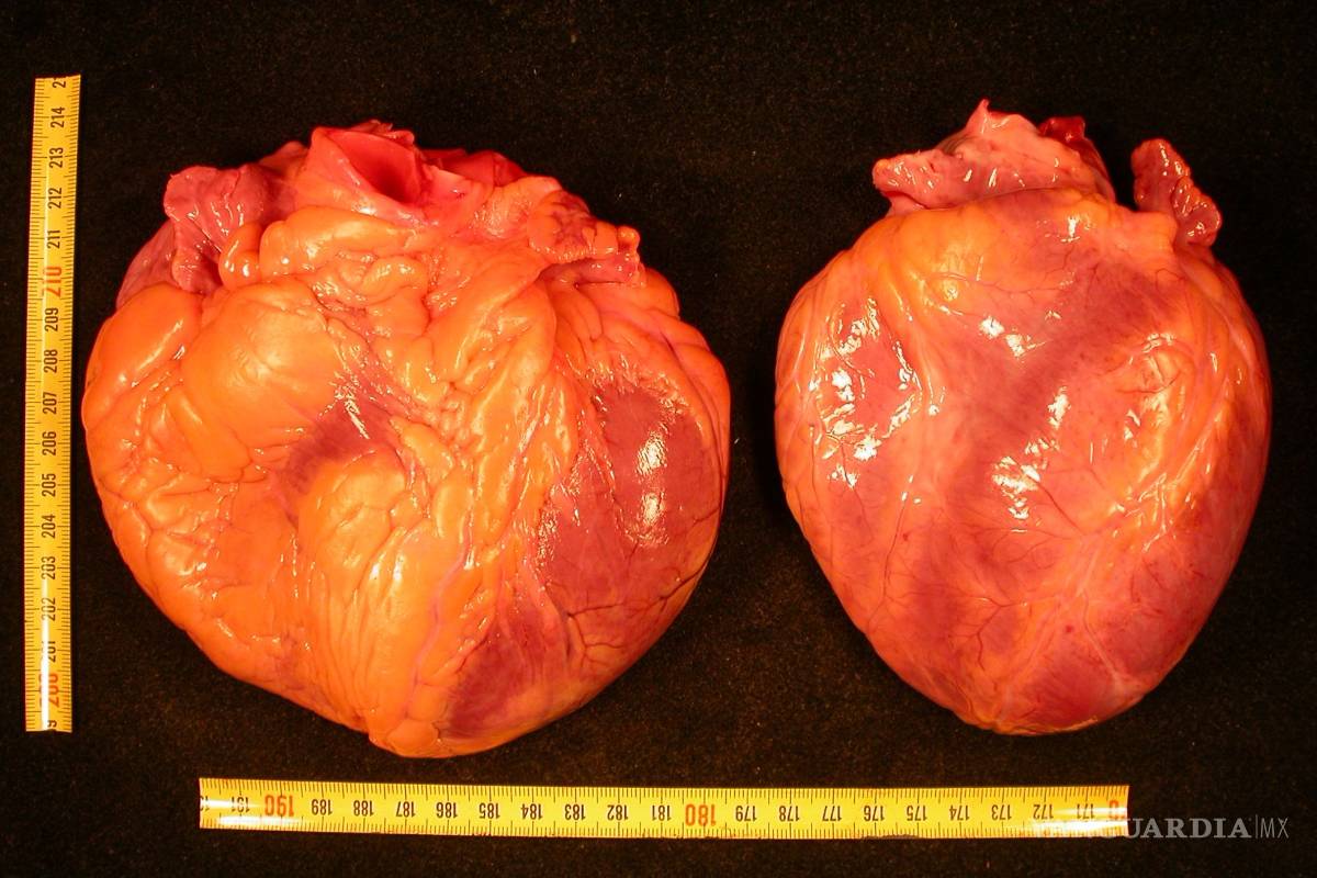 Una enfermedad mortal del corazón solo para hombres