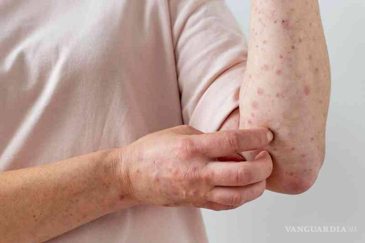 Será México sede de capacitación sobre detección de viruela símica, afirma OPS